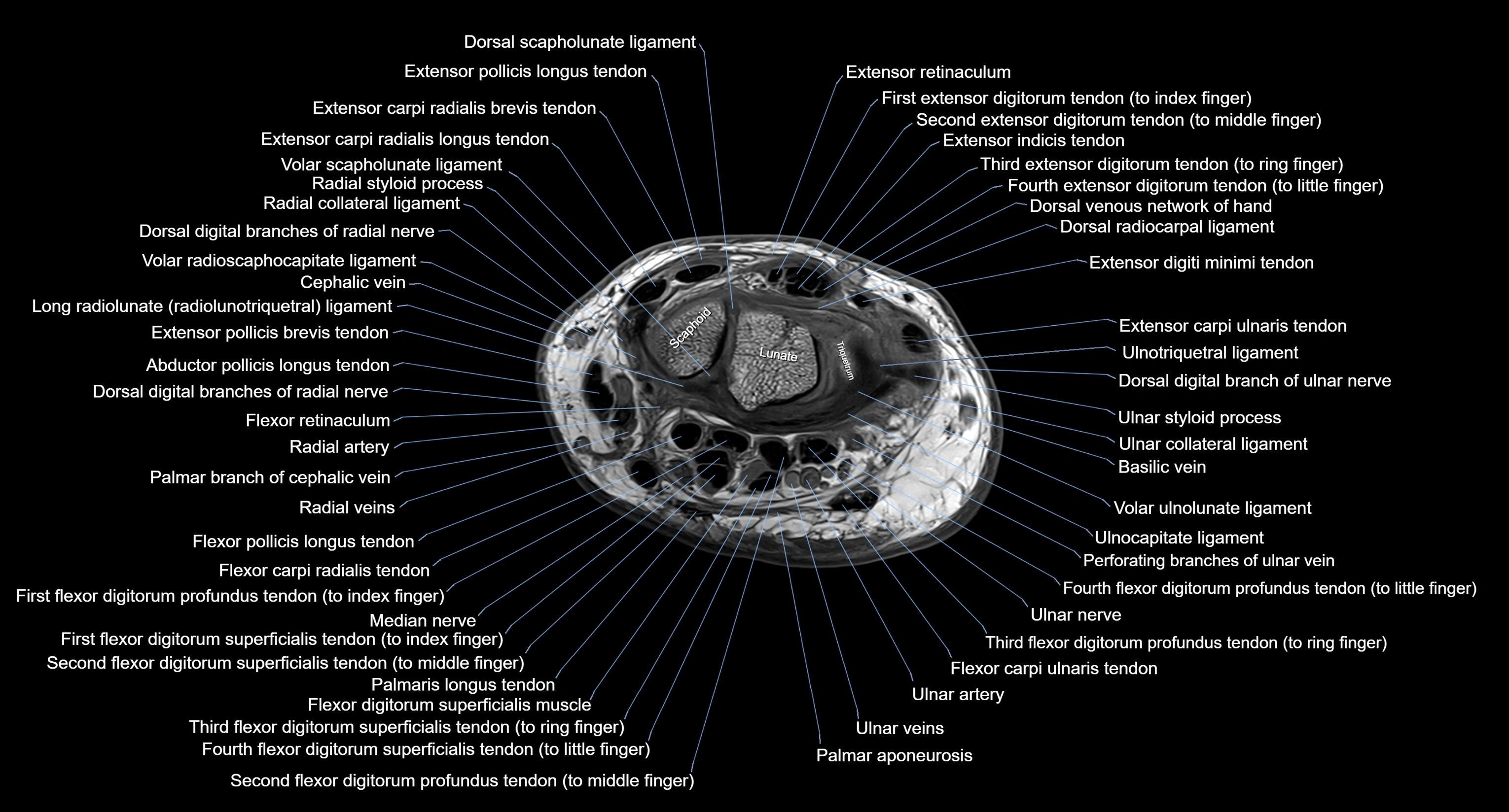 MRI wrist axial cross sectional anatomy 3T radiology  image-img-00001-00022.webp